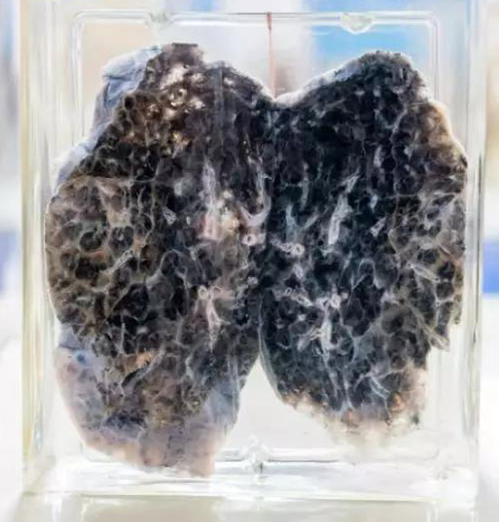 患了癌的肺,胃,肝都长什么样?